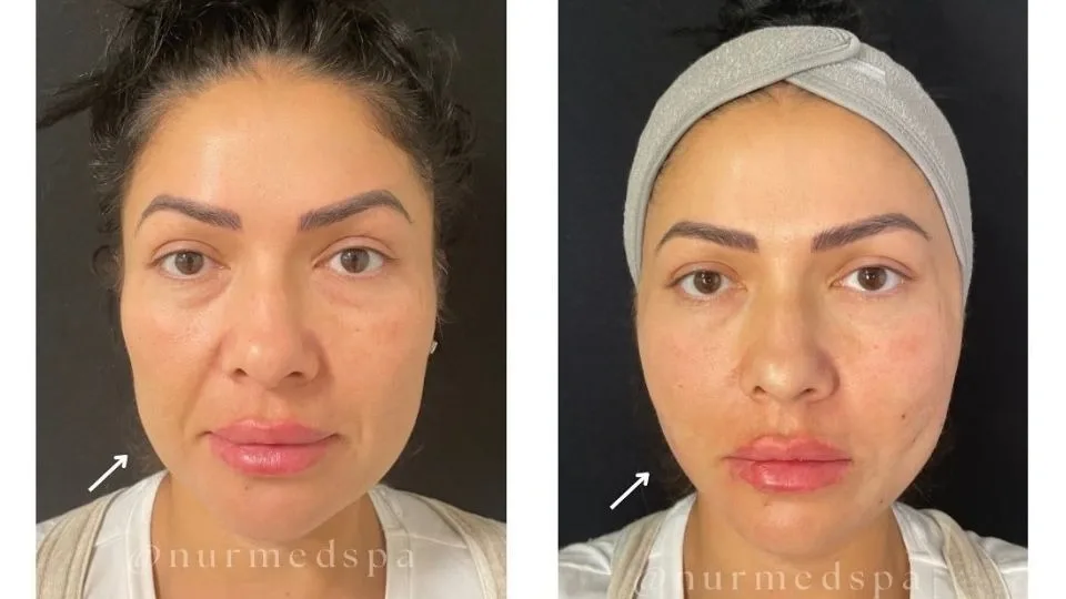 Botox results in different areas of the face
