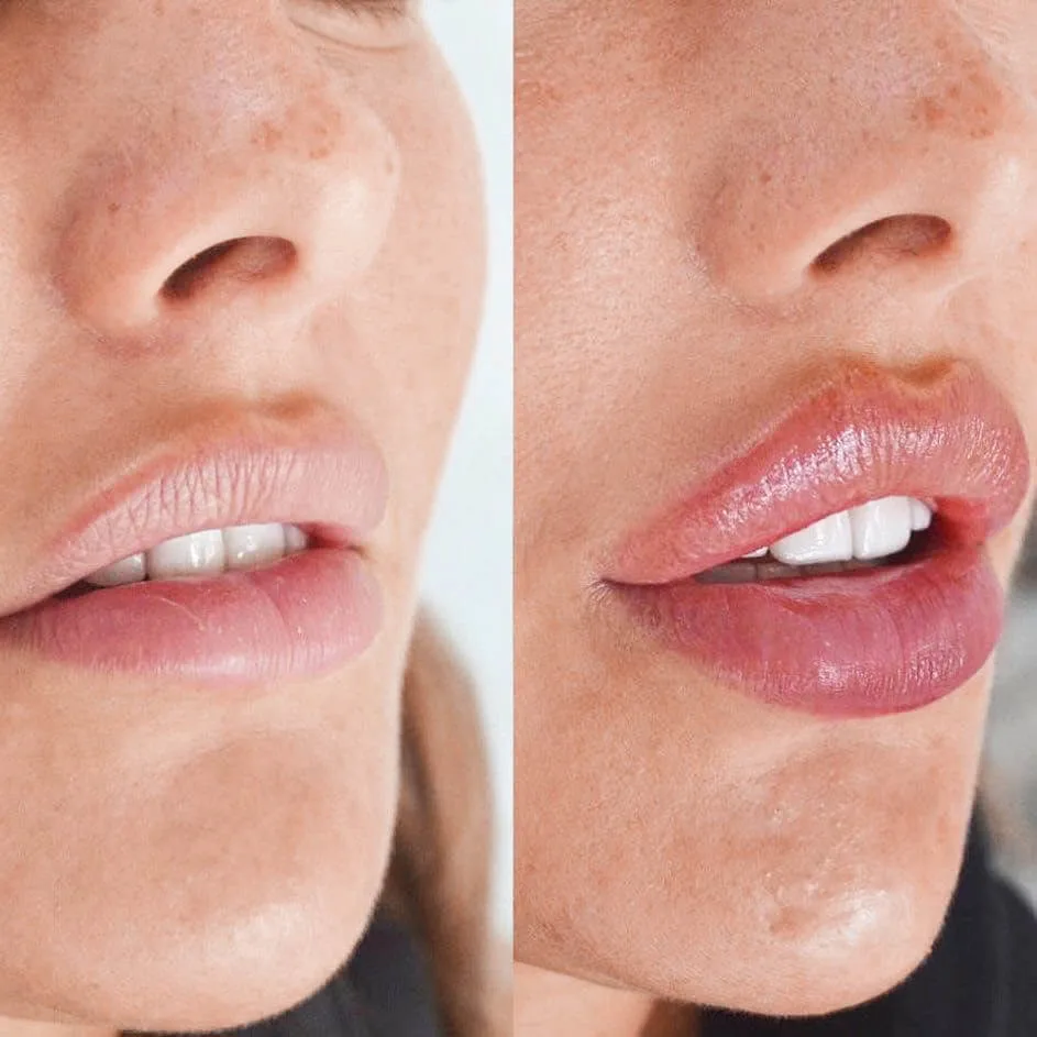 Woman receiving Botox for lips