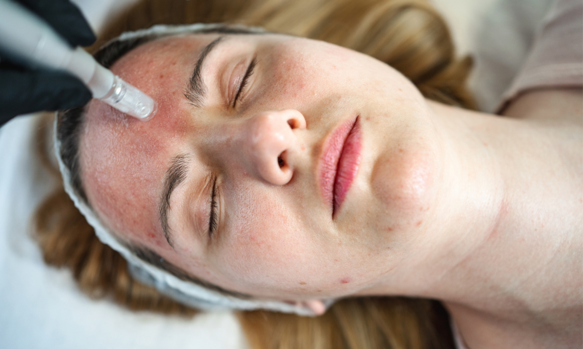 A woman lying down while a provider puts a needle in her lip