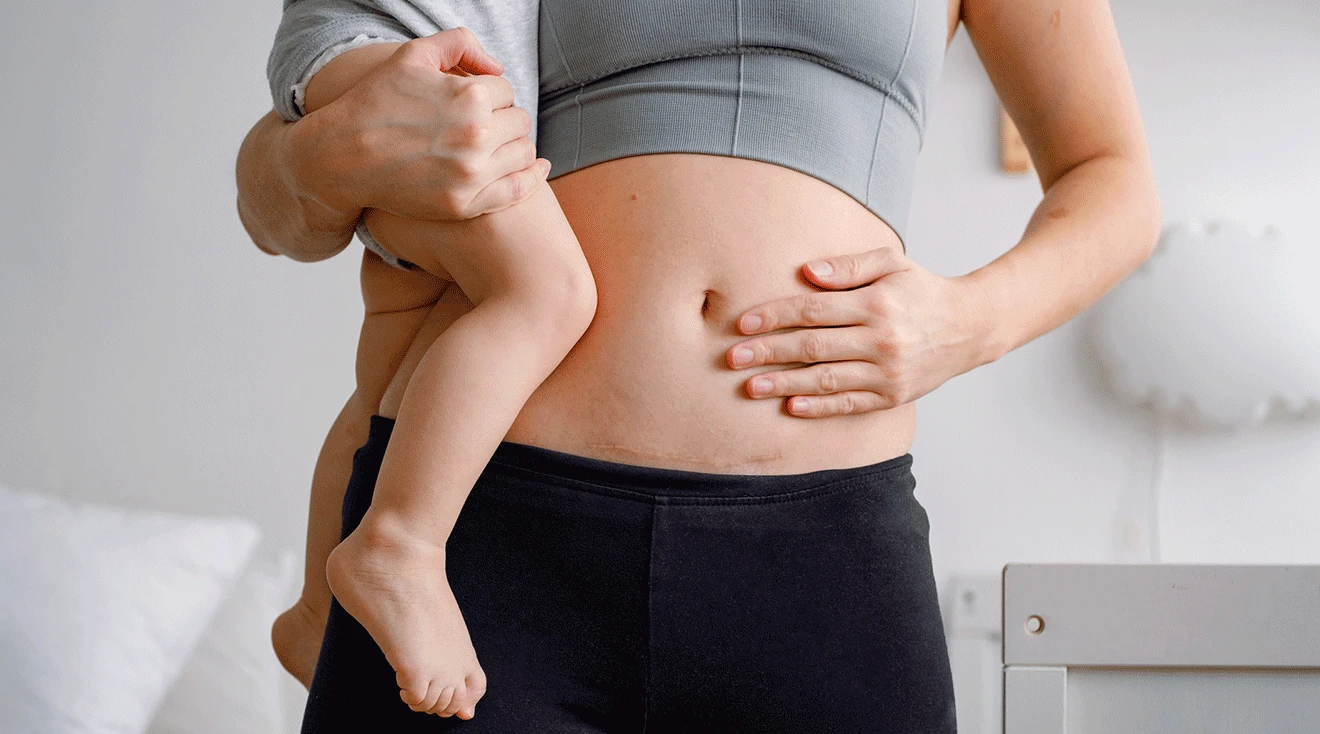 mom showing c section scar while holding baby