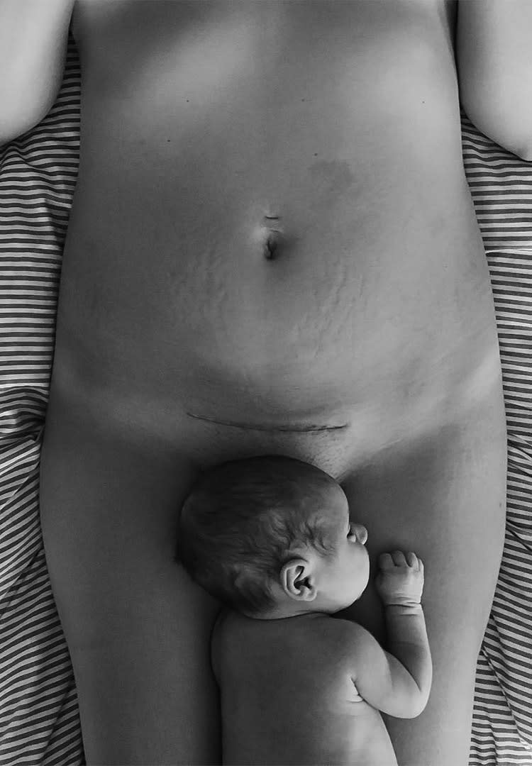 c-section-scar-b-w-laying-down-baby