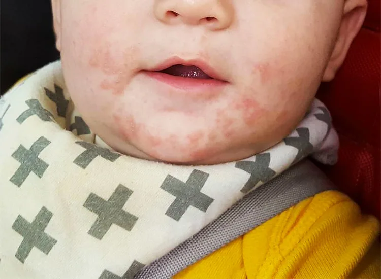 rash in babies