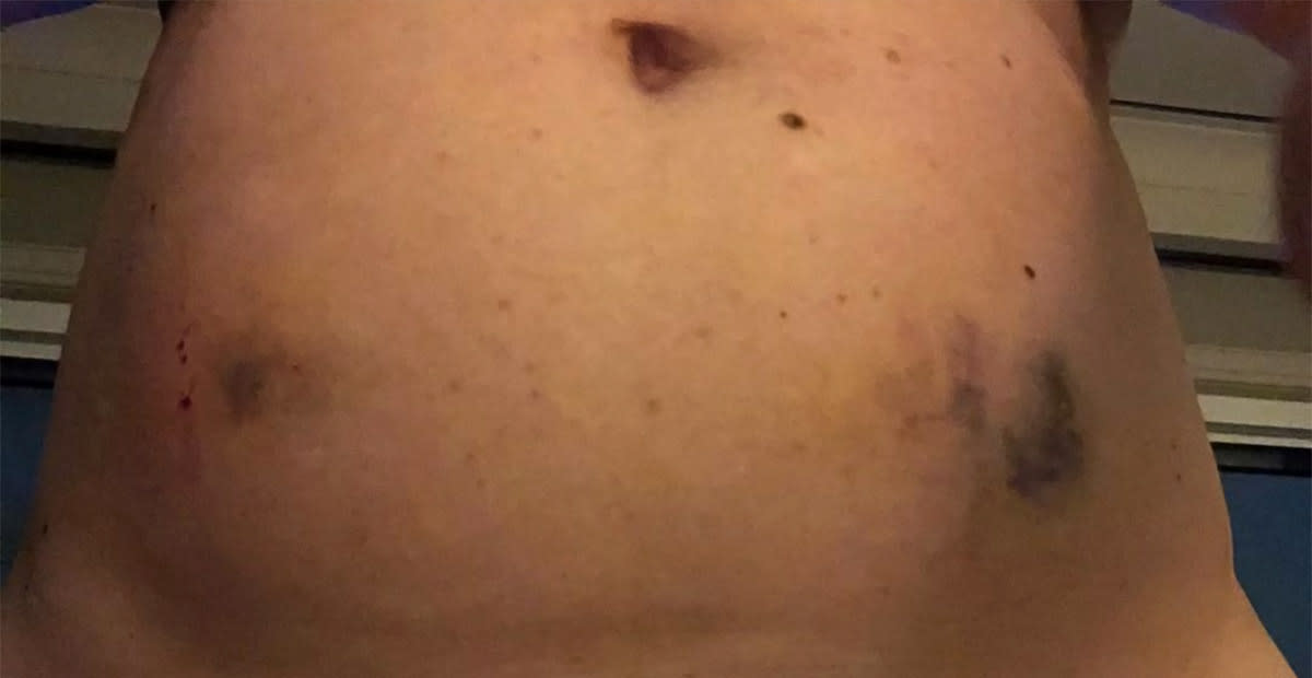 Amy Schumer Reveals IVF Struggle and Reaches Out to Fans for Support Amy Schumer Reveals IVF Struggle and Reaches Out to Fans for Support