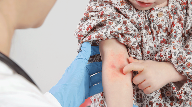 doctor examining child with eczema on arm