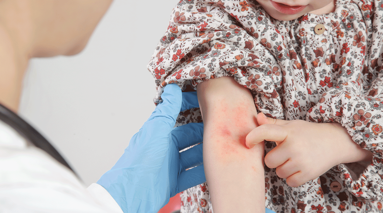 doctor examining child with eczema on arm