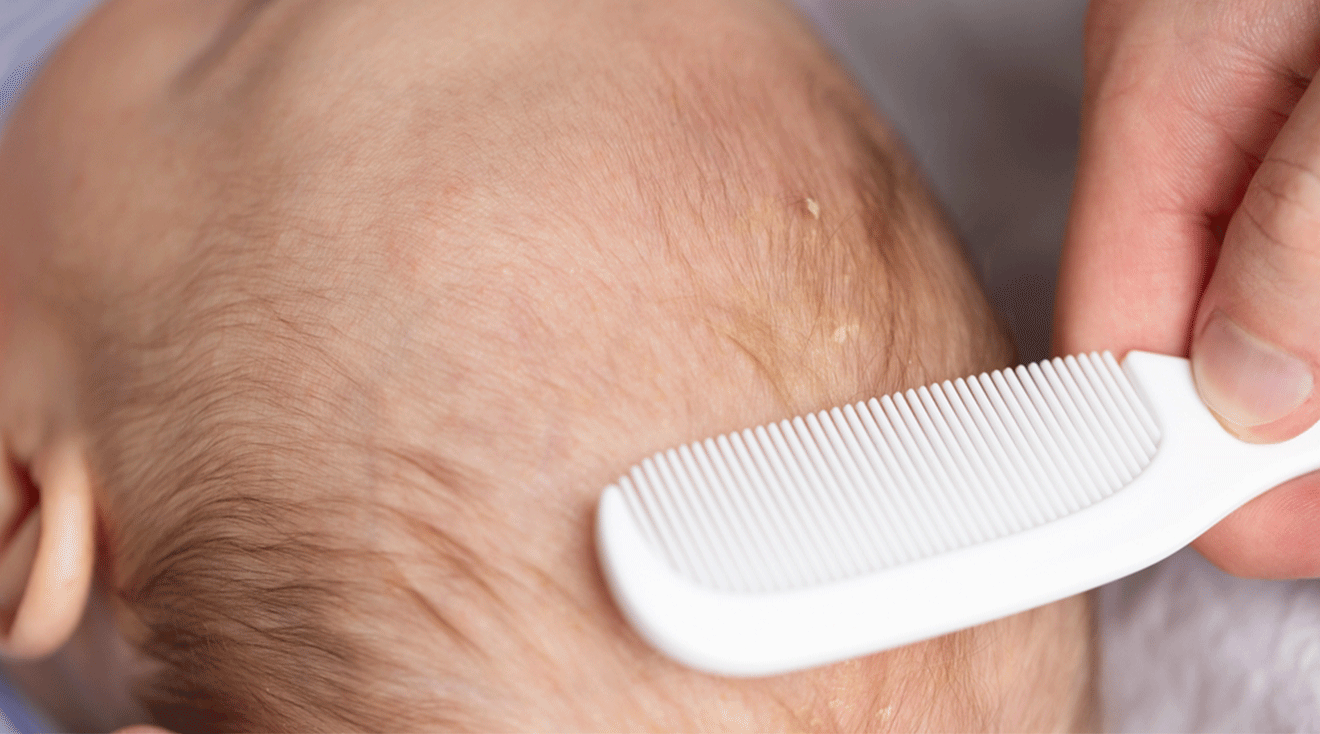 brushing baby hair with cradle cap