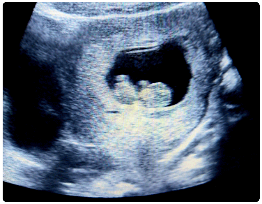10 week ultrasound-in body