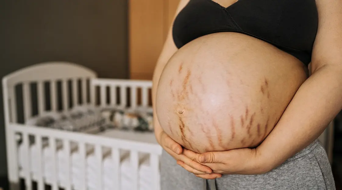 Prevent Stretch Marks During Pregnancy - Stretch Marks Diet - Moms