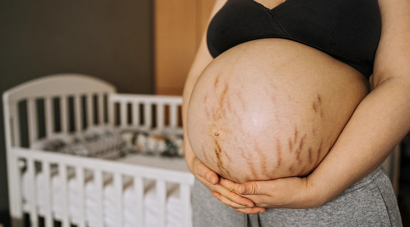 stretch marks after pregnancy on black women