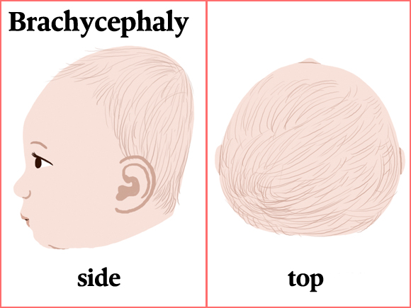 Types best sale of plagiocephaly