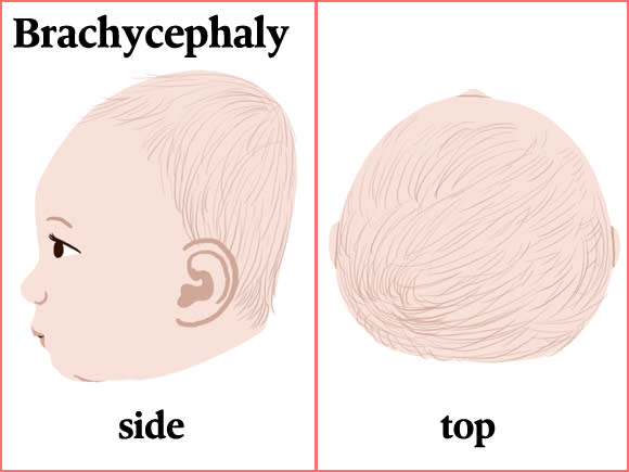 Plagiocephaly–Flat Head Syndrome