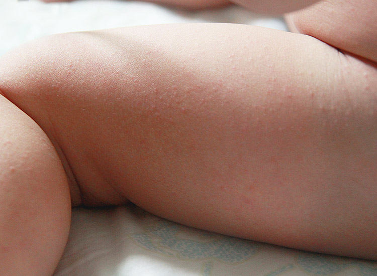 baby dry skin on legs