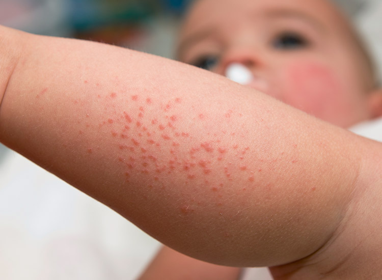 infant red pinpoint rash