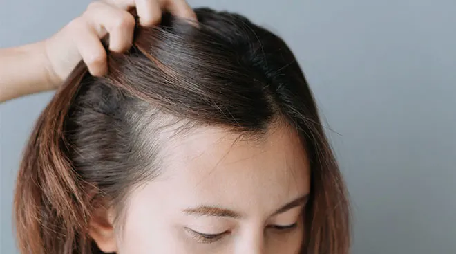 woman showing her hair thinning around her temples