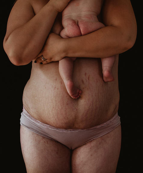 This Mom's Photo Series Highlights The Beauty of Postpartum Bodies