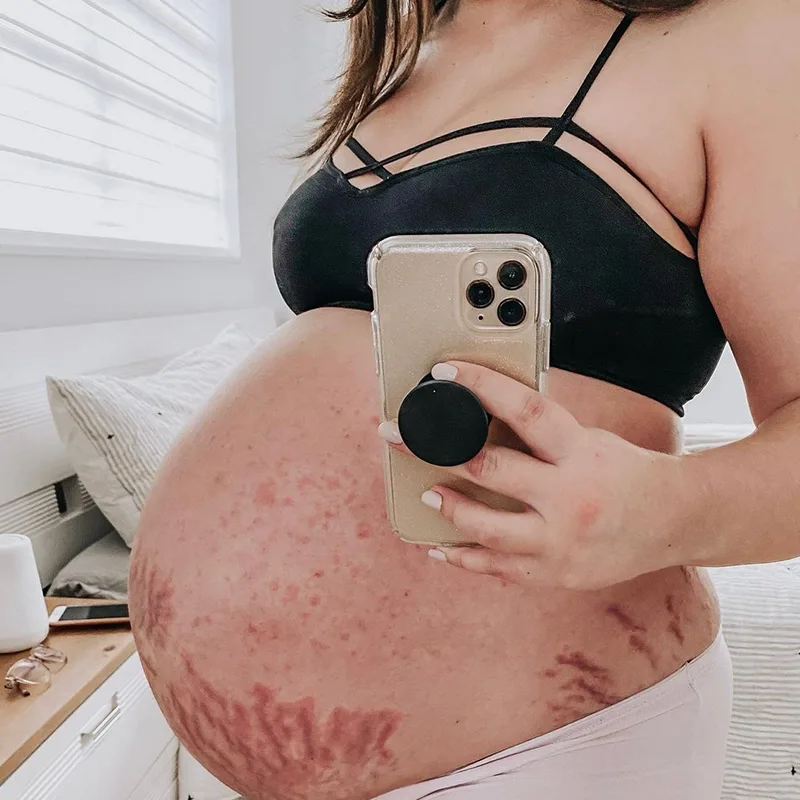 Hives From Pregnancy: Reasons, Signs & Treatment