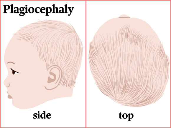 Plagiocephaly–Flat Syndrome