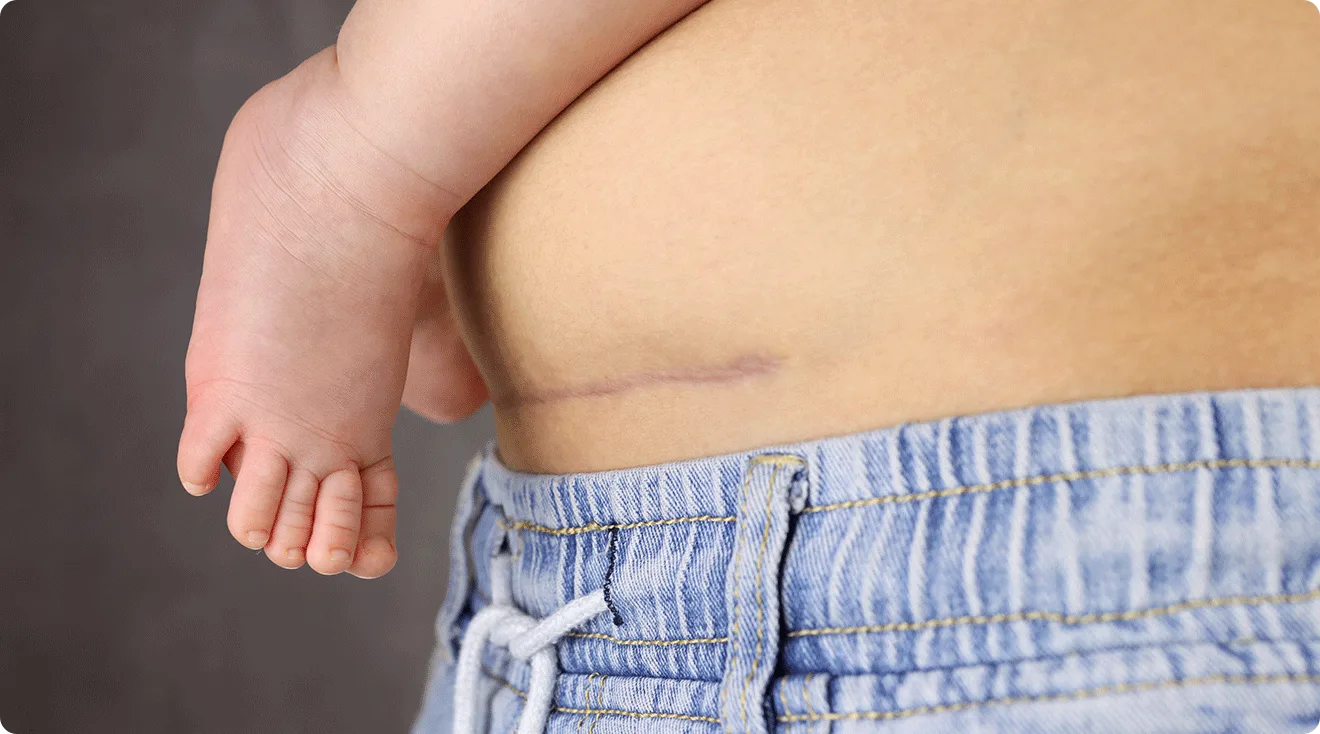 mom with c section scar holding baby