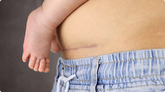 mom with c section scar holding baby