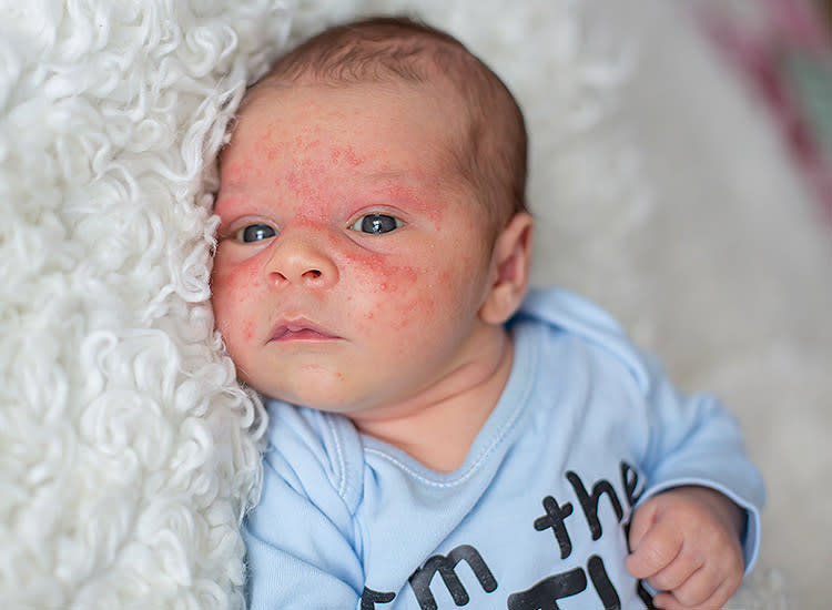 punktum plade Termisk Baby Eczema: Symptoms, Causes and Treatments