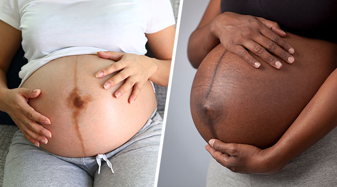 Linea Nigra What to Know About the Pregnant Belly Line