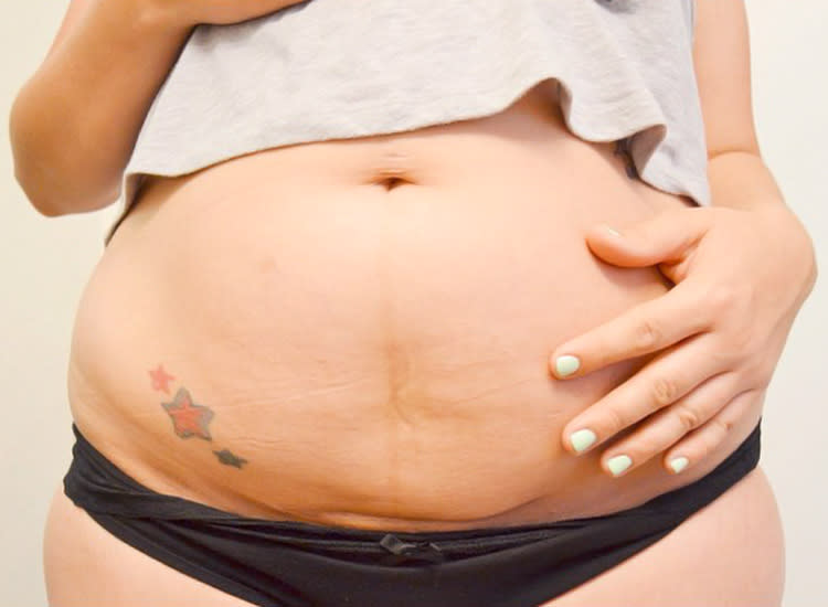 10 Beautiful C-section Scars