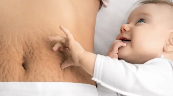 baby next to mom's belly with stretch marks