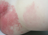 Toddler Yeast Infection Online Toddler Yeast Infection Online