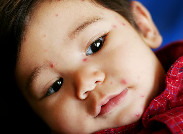 heat rash on face toddler