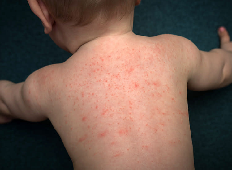 Baby rash: Causes and when to see a doctor