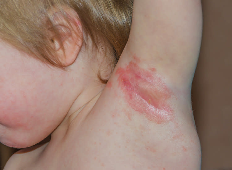 14 Common Rashes in Babies and Kids