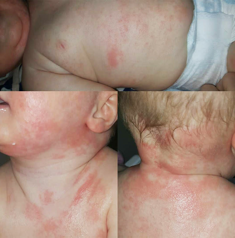 eczema on baby neck