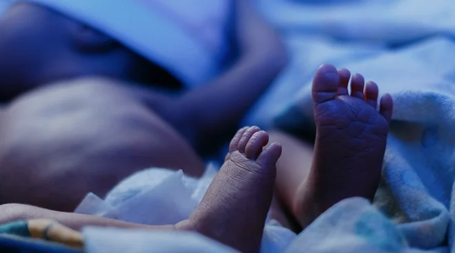 A newborn baby with elevated bilirubin lies under a blue lamp for phototherapy treatment