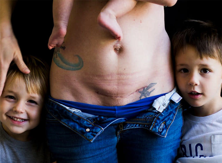 c-section-scar-mom-3-kids