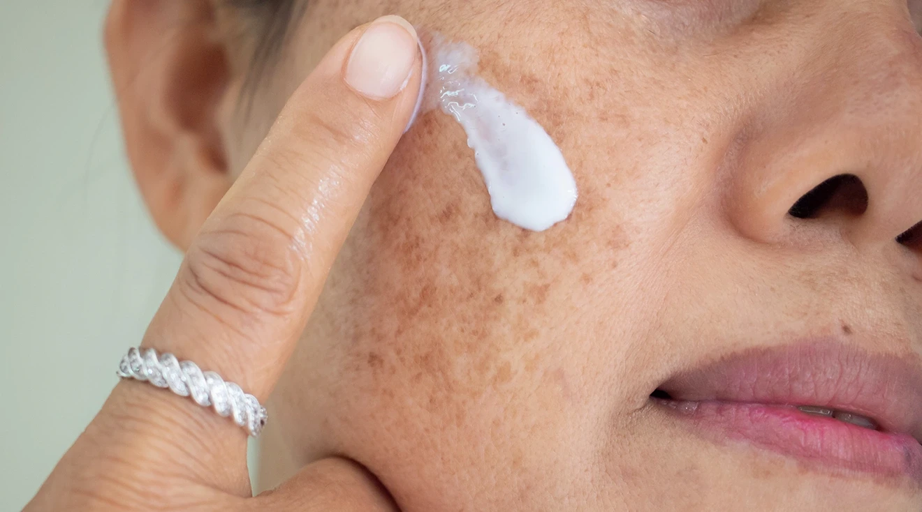 woman applying cream to melasma on face