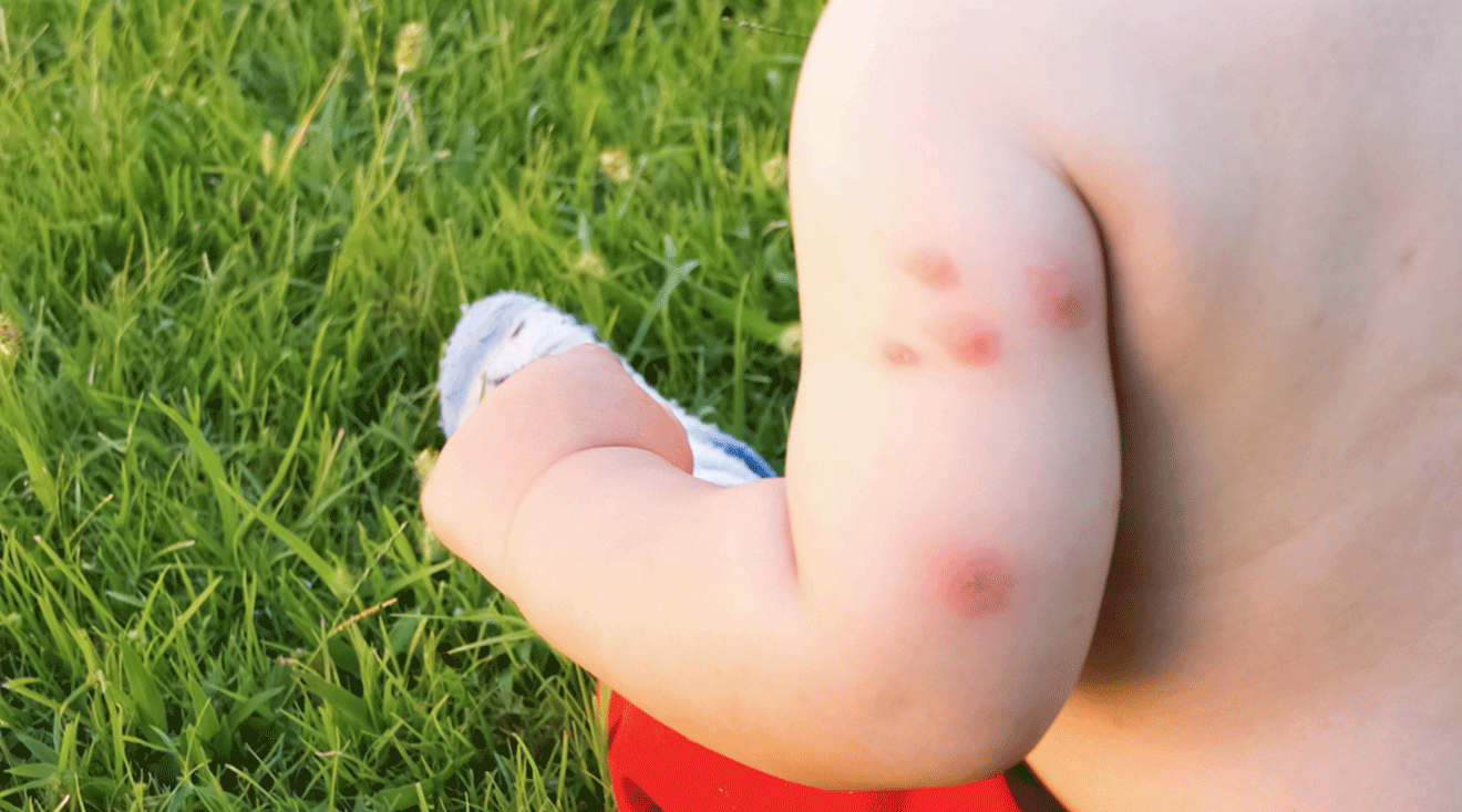 bug bites on baby's arm outside