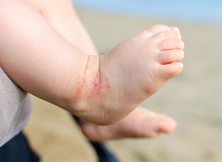 Baby Eczema Causes And Treatments