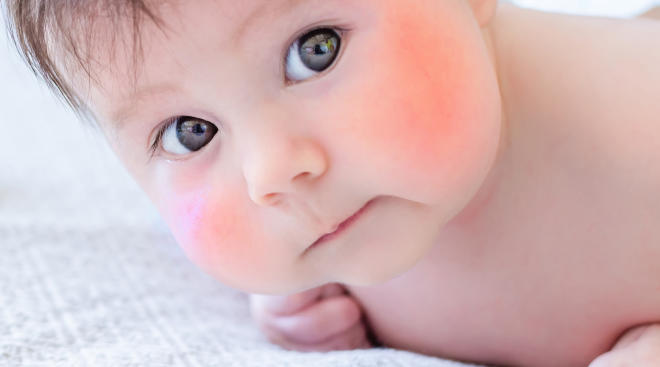 Beskrive håndtag Vugge Fifth Disease in Babies & Kids: Symptoms & Treatment