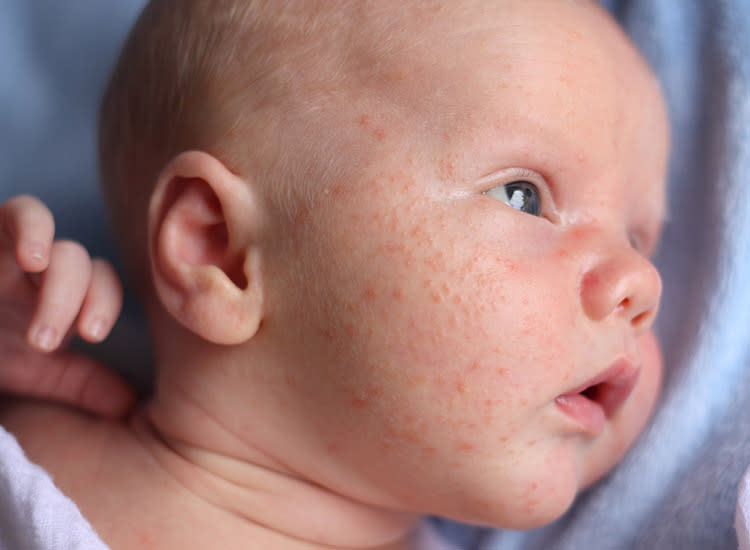 baby dry skin rash
