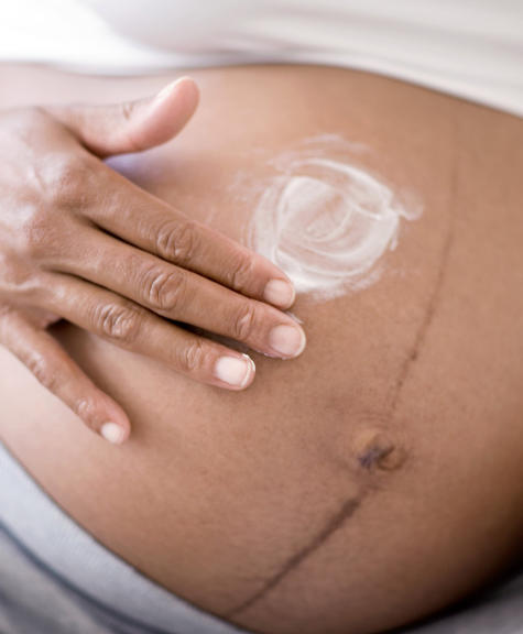 Best cream to use during pregnancy to prevent stretch marks How To Get Rid Of Stretch Marks