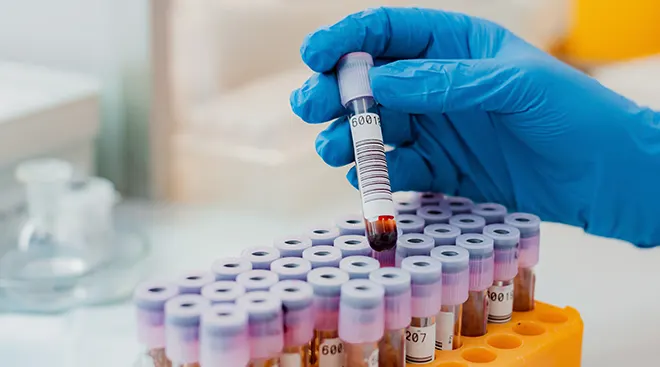 lab technician holding vial of blood for blood testing