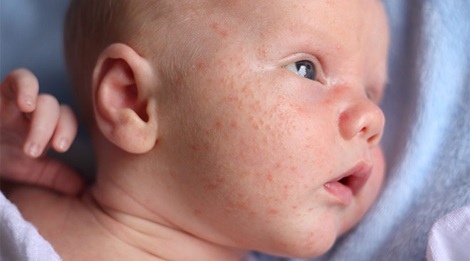 Newborn baby close-up of its face with baby acne. 
