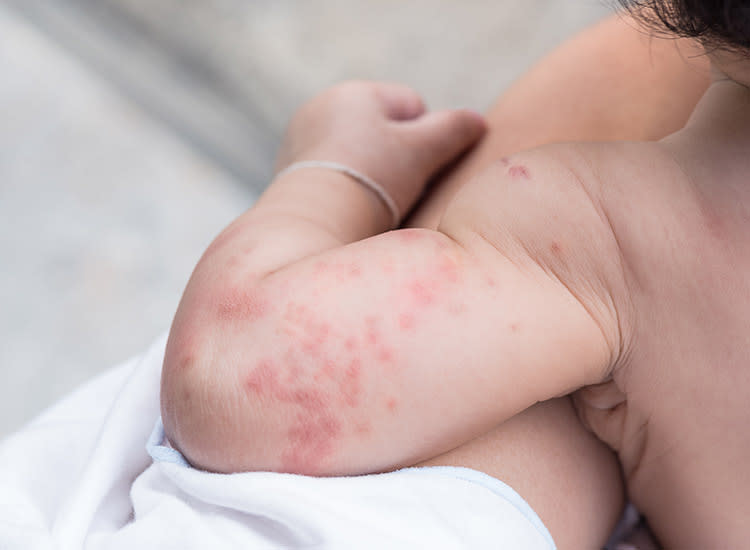 allergic reaction rash on babies
