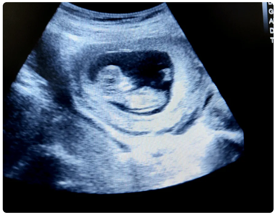 11 Weeks Pregnant Ultrasound: Pictures, Prep and More