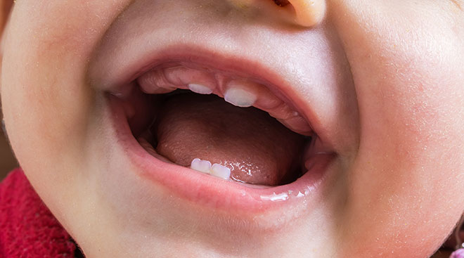 close up of baby's mouth with lip tie