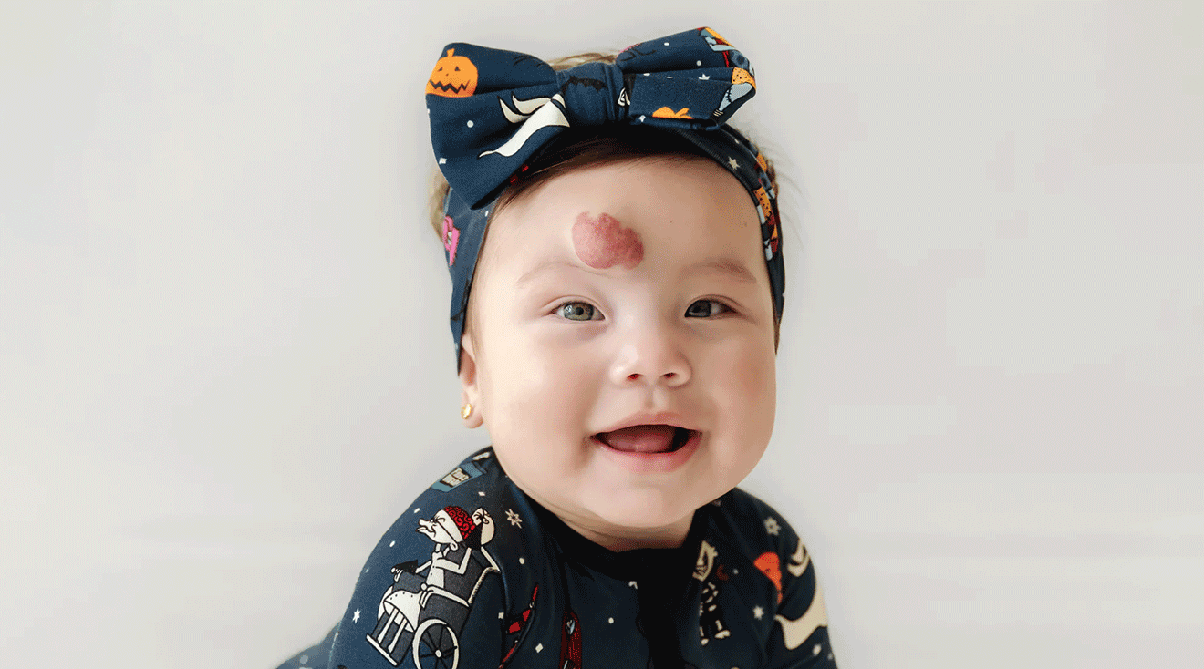 Little Sleepies Features Baby with Hemangioma in New Ad