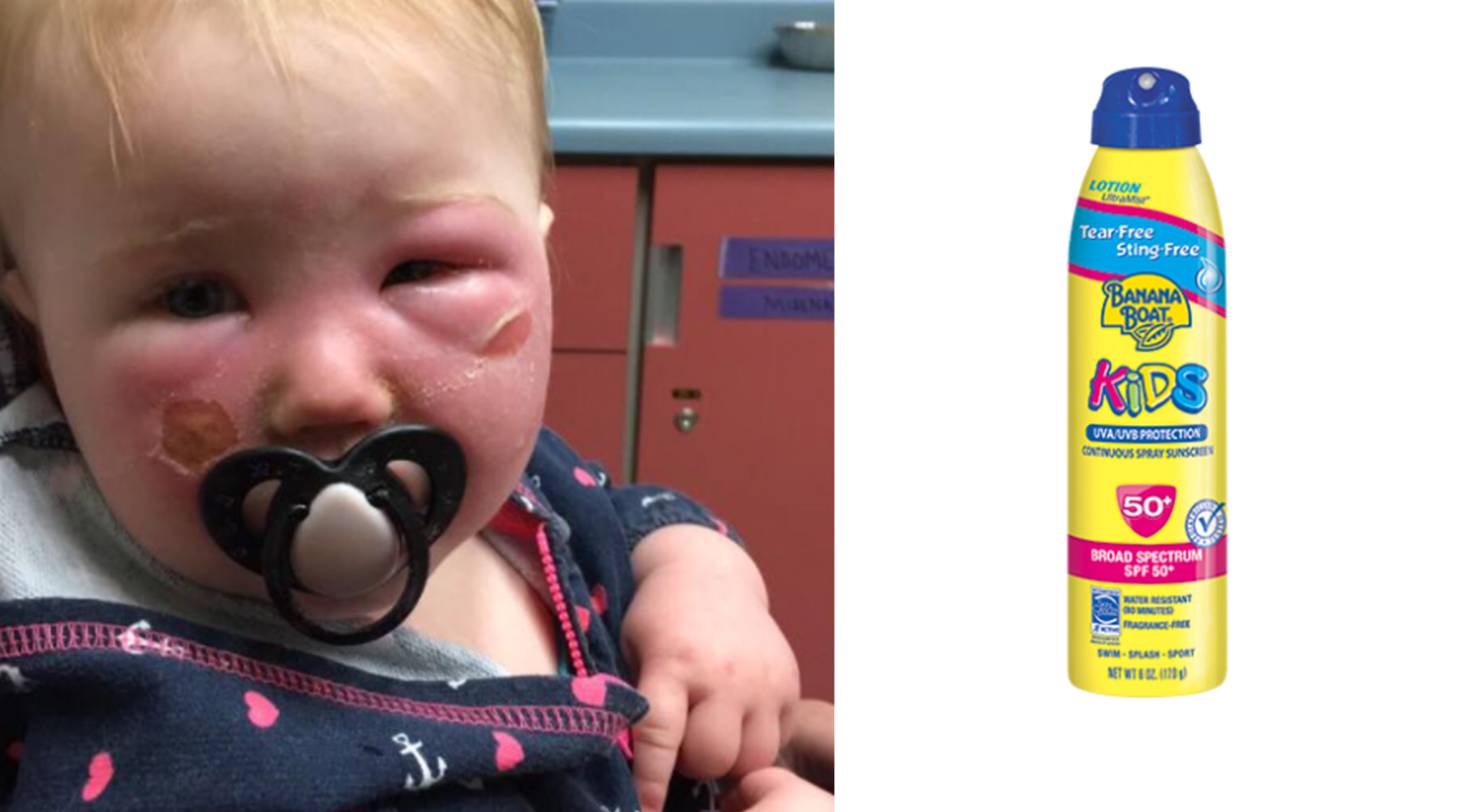 Baby with severe burns on face from sunscreen