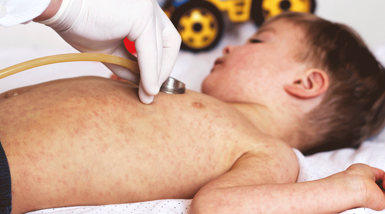 doctor evaluating child with measles rash