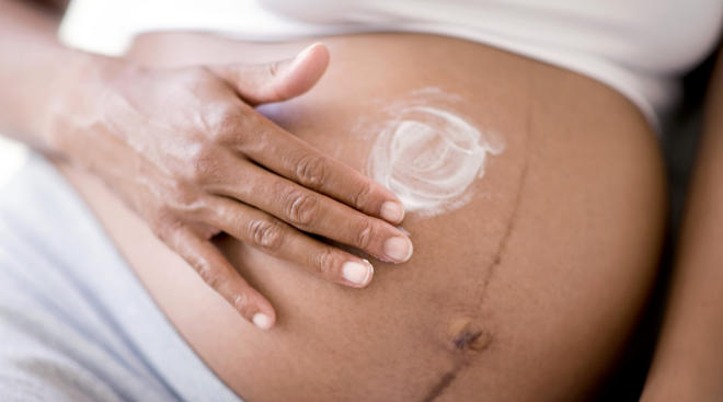 4 Ways to Get Rid of Stretch Marks (And 1 Surefire Way to Hide Them for  Good)