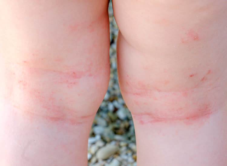 baby dry skin rash